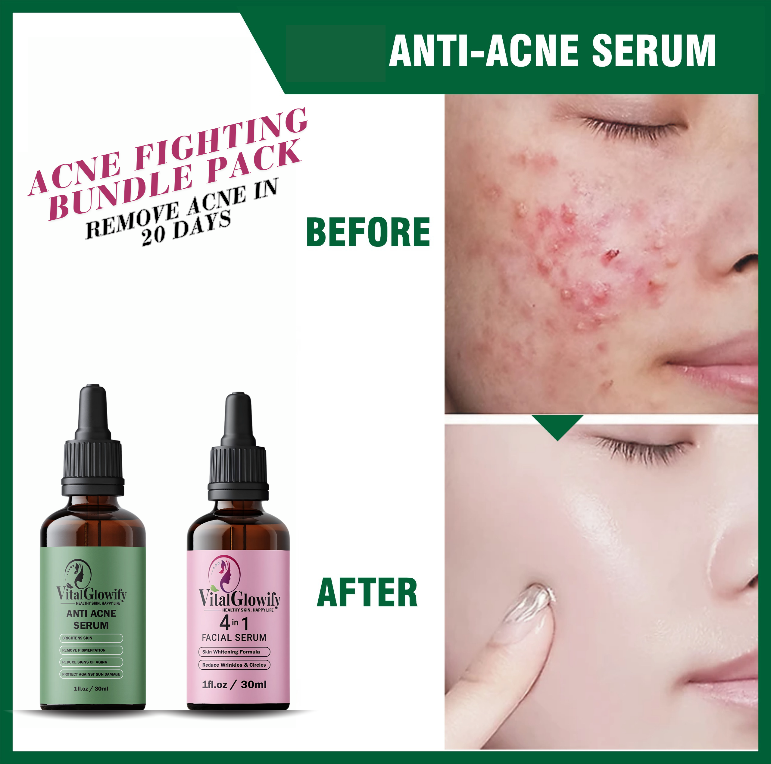 Acne Fight Bundle Pack