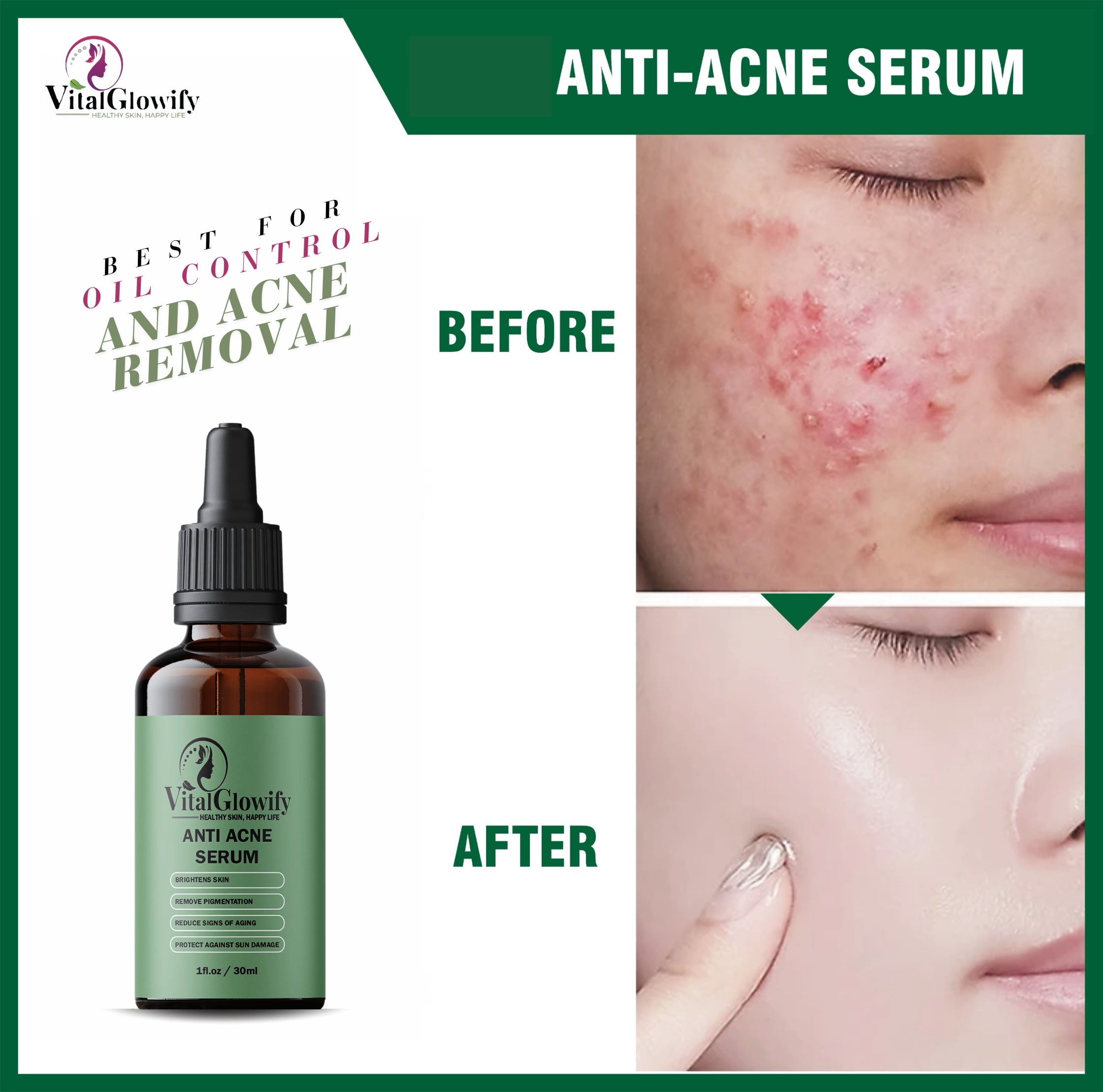 Anti Acne serum with Salicylic Acid for oil Control and Acne Removal-30ML